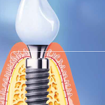 Brochure van het Ivoren Kruis over Implantaten